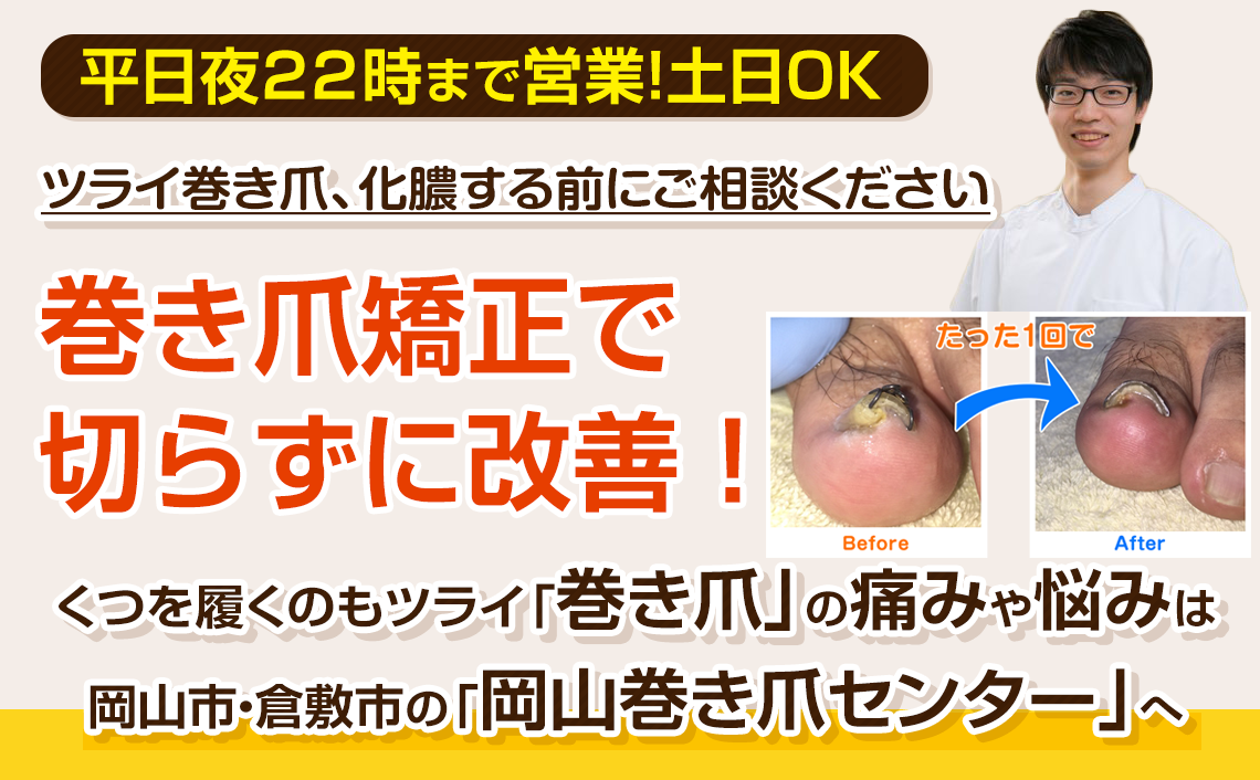 岡山市 倉敷市で巻き爪の矯正なら 岡山巻き爪センター へ